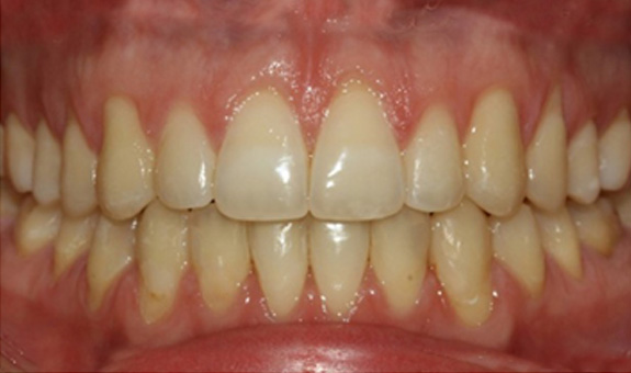 1-after